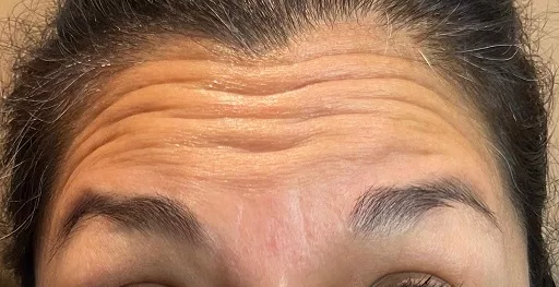 Koža pred uporabo obližev LUMINE