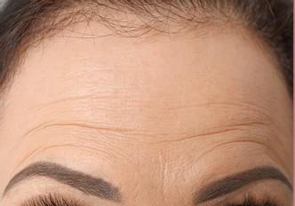 Koža pred uporabo obližev LUMINE