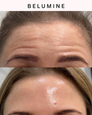 Silikonski obliž za gube na čelu