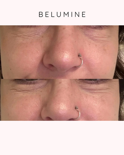 Silikonski obliž za gube okoli oči