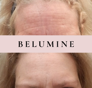 Silikonski obliž za gube na čelu